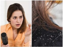 tips to remove dandruff