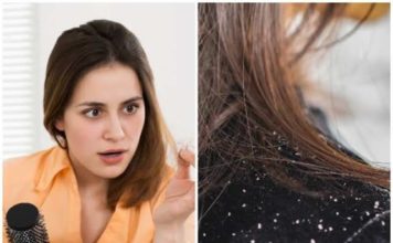 How To Solve Dandruff Problem Naturally | Tips to remove dandruff | பொடுகு தொல்லை போக்க உங்களுக்கான நிரந்தர தீர்வு இதோ..! tips to remove dandruff