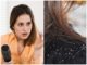 How To Solve Dandruff Problem Naturally | Tips to remove dandruff | பொடுகு தொல்லை போக்க உங்களுக்கான நிரந்தர தீர்வு இதோ..! tips to remove dandruff